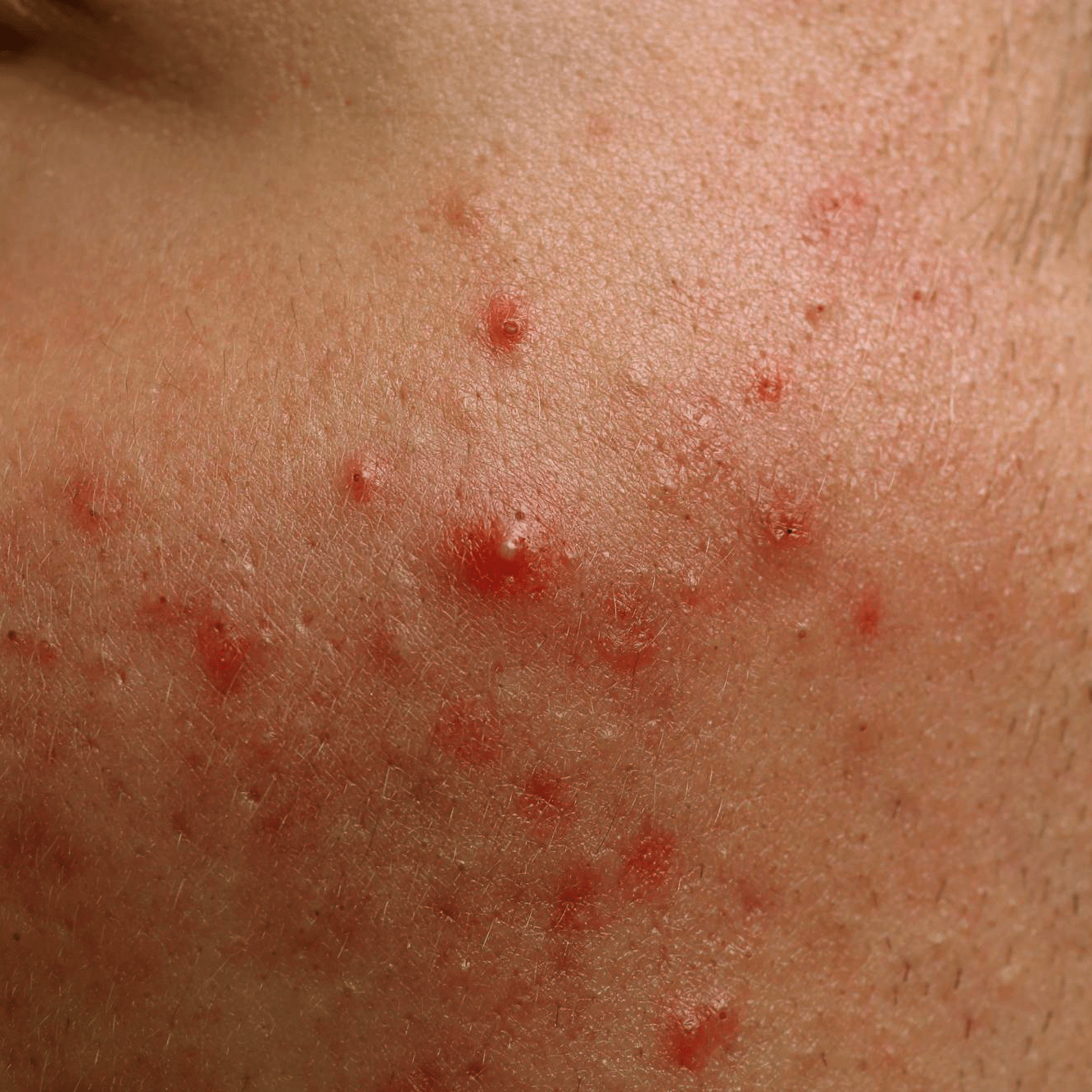 How To Treat Acne? - /PHD/ - Proven Honest Derma