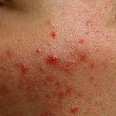 Acne
