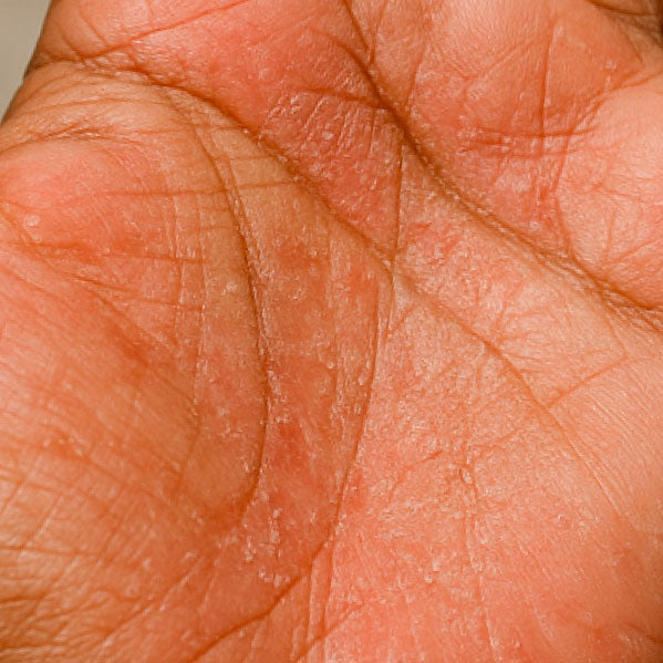 Before using 1% Ceramides Intensive Repair Cream