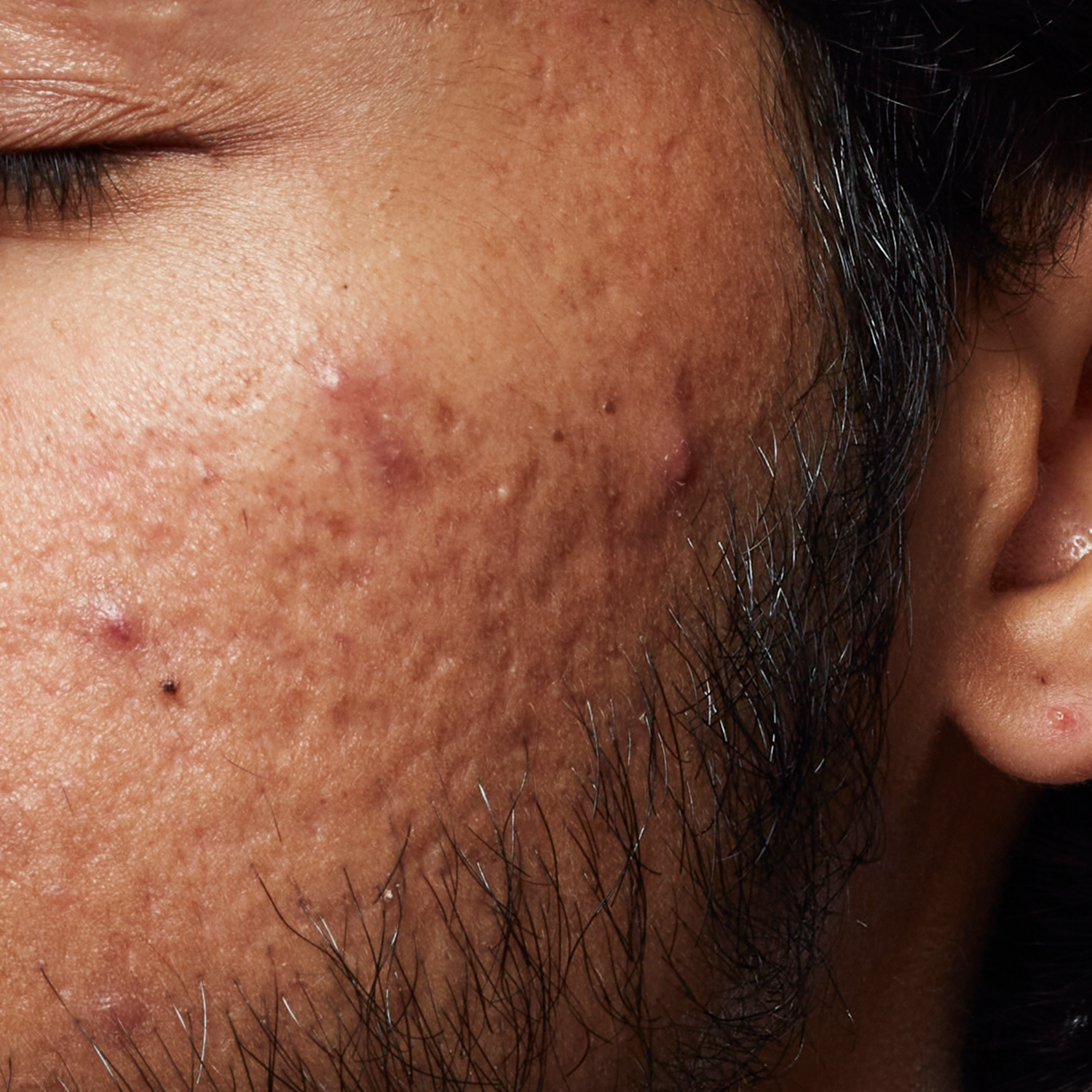 Oily and Acne-Prone Skin