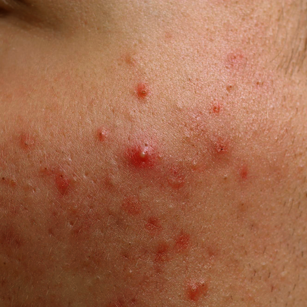 How To Treat Acne?