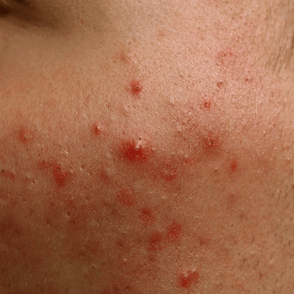 How To Treat Acne?