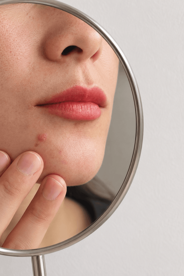 Retinol Purging vs a Breakout: How Can You Tell the Difference?