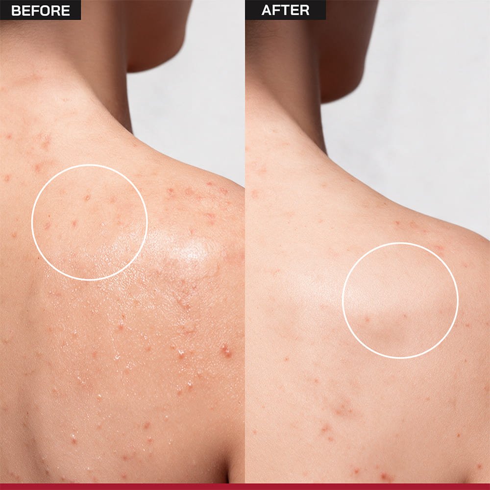 5% AHA BHA Exfoliating Bodywash - /PHD/ - Proven Honest Derma