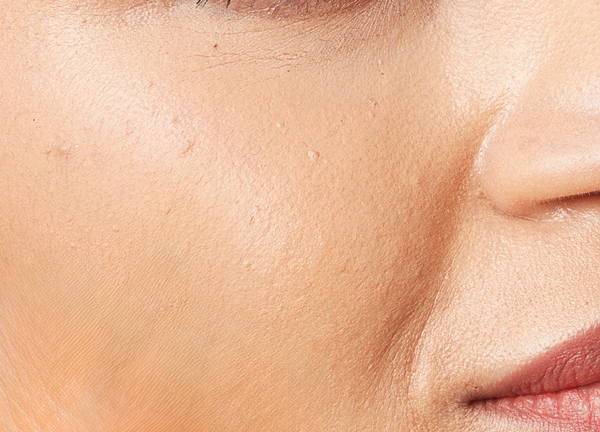 After using Salicylic Acid Acne Spot Treatment Gel
