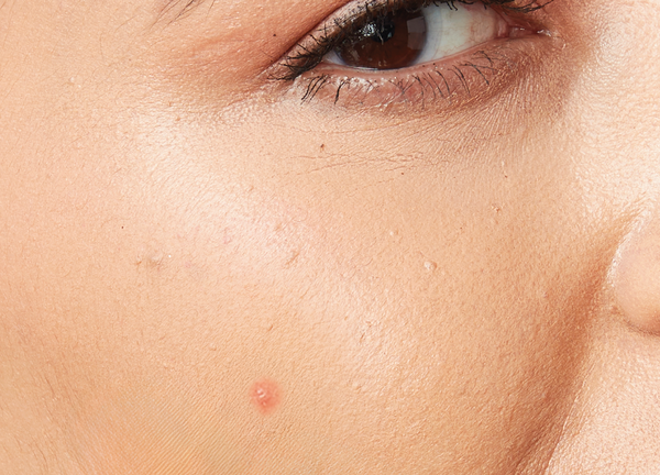 Before using Salicylic Acid Acne Spot Treatment Gel