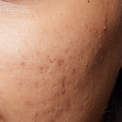 Acne Marks