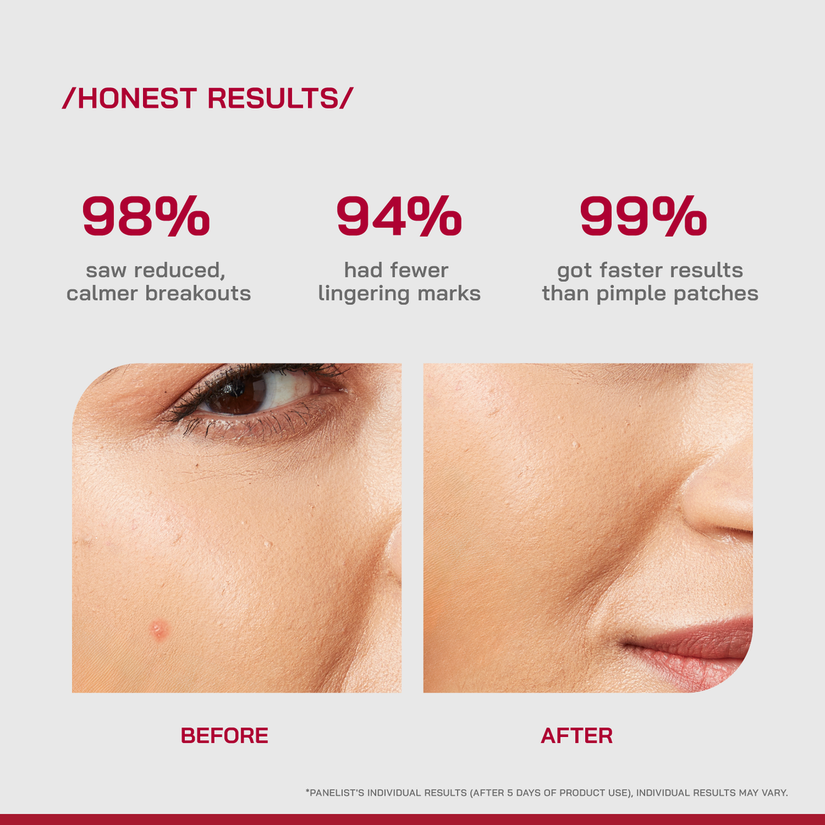 Salicylic Acid Acne Spot Treatment Gel