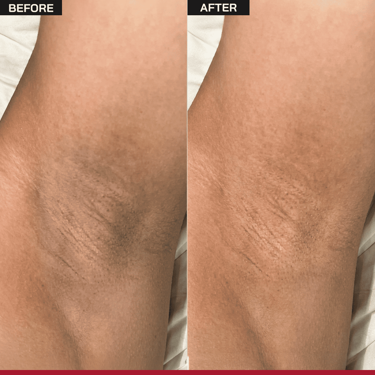 6% AHA Underarm Depigmentation Roll-On