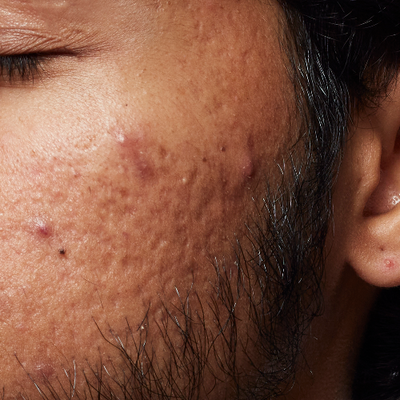 Oily and Acne-Prone Skin