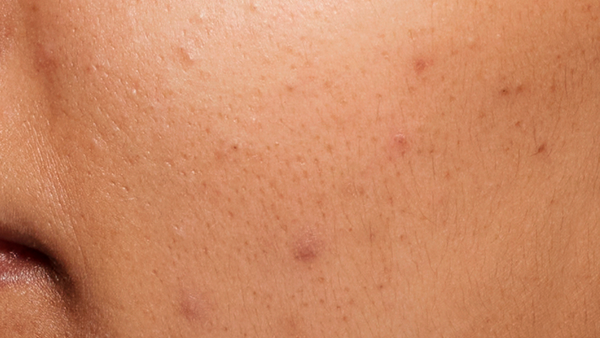 Before using 10% Niacinamide Spot Correcting Serum