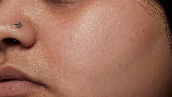 After using 2% Hyaluronic Acid Dewy Skin Serum