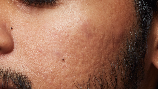 After using 2% Salicylic Acid Anti-Acne Serum