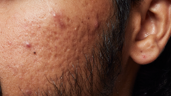 Before using 2% Salicylic Acid Anti-Acne Serum