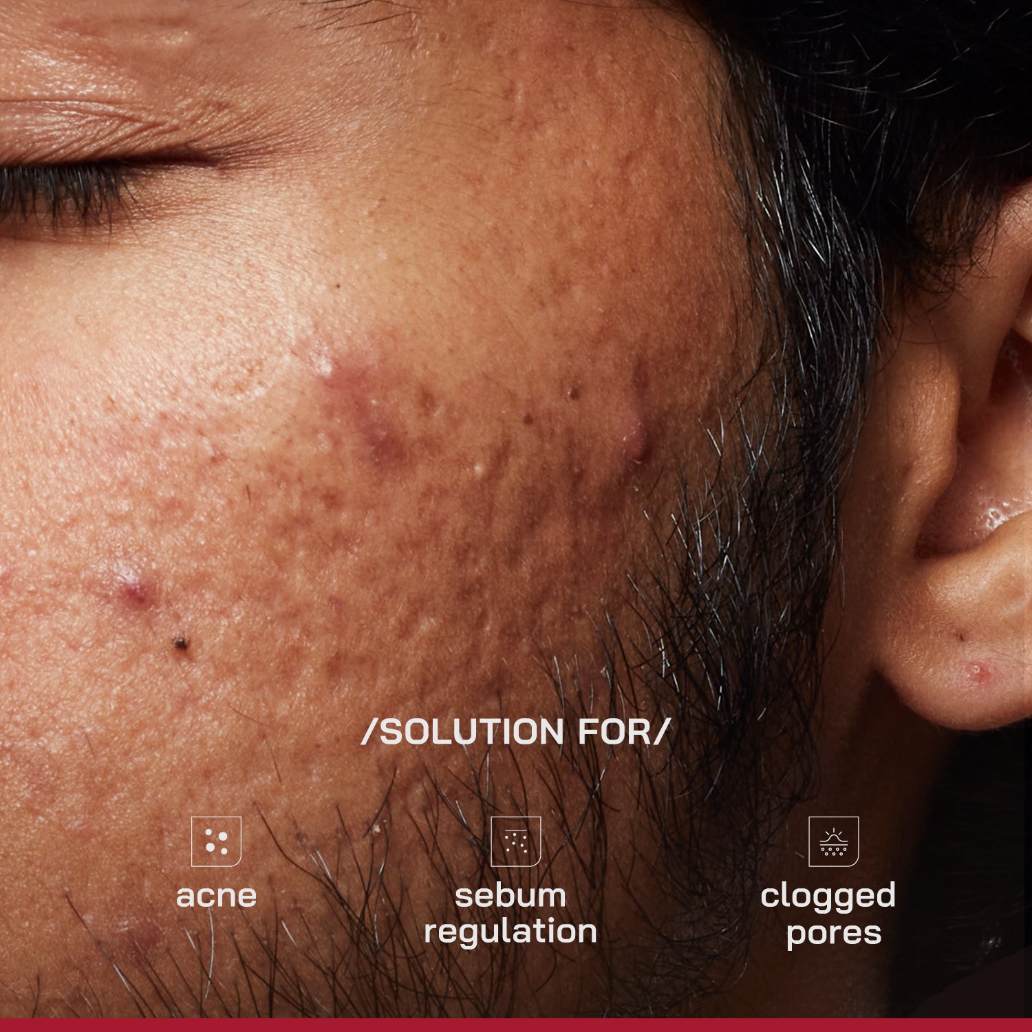 2% Salicylic Acid Anti-Acne Serum