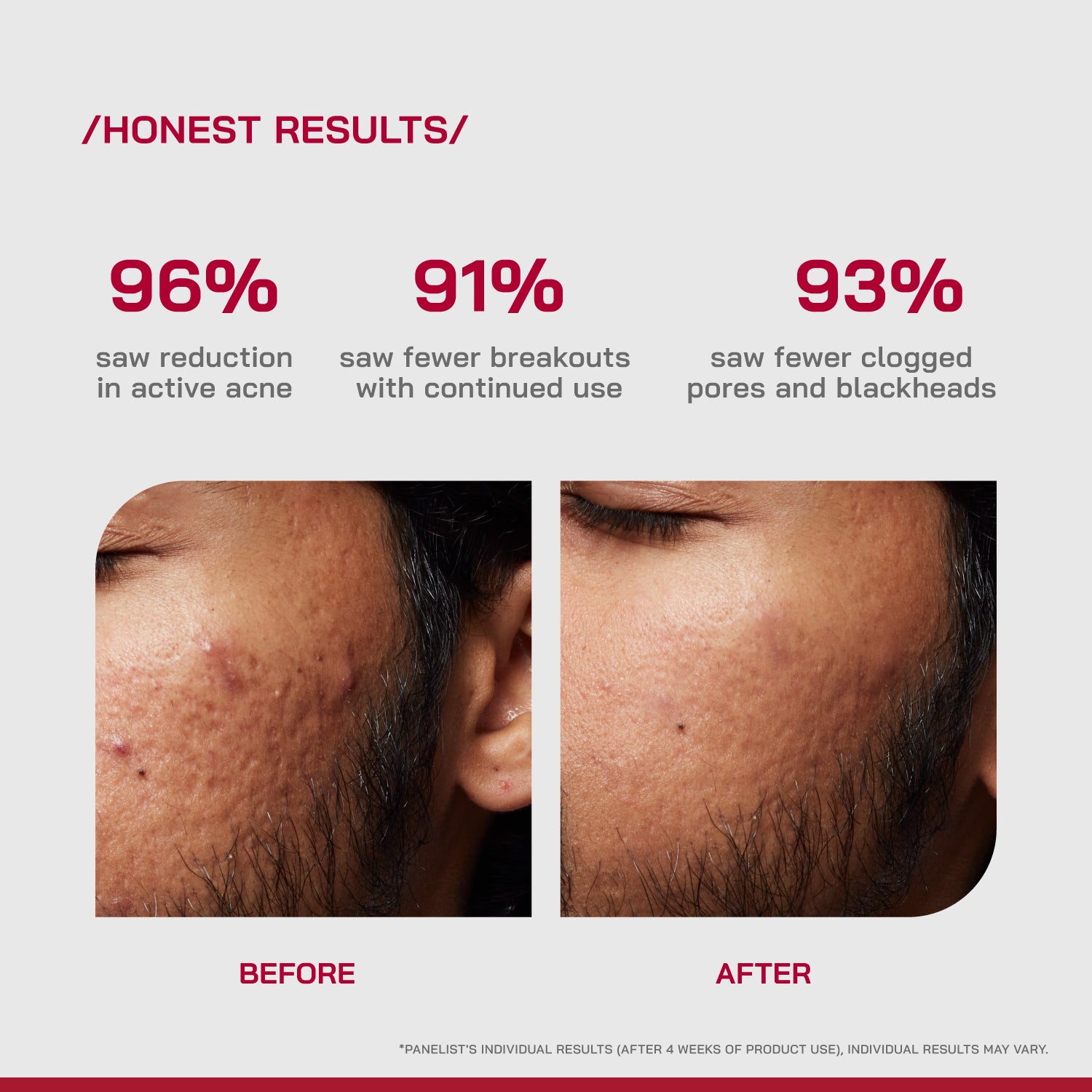 2% Salicylic Acid Anti-Acne Serum