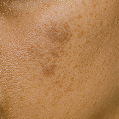Pigmentation